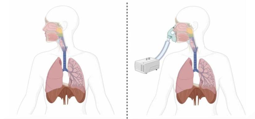Graphic from the research paper showing a representation of the respiratory system with and without a CPAP machine in use