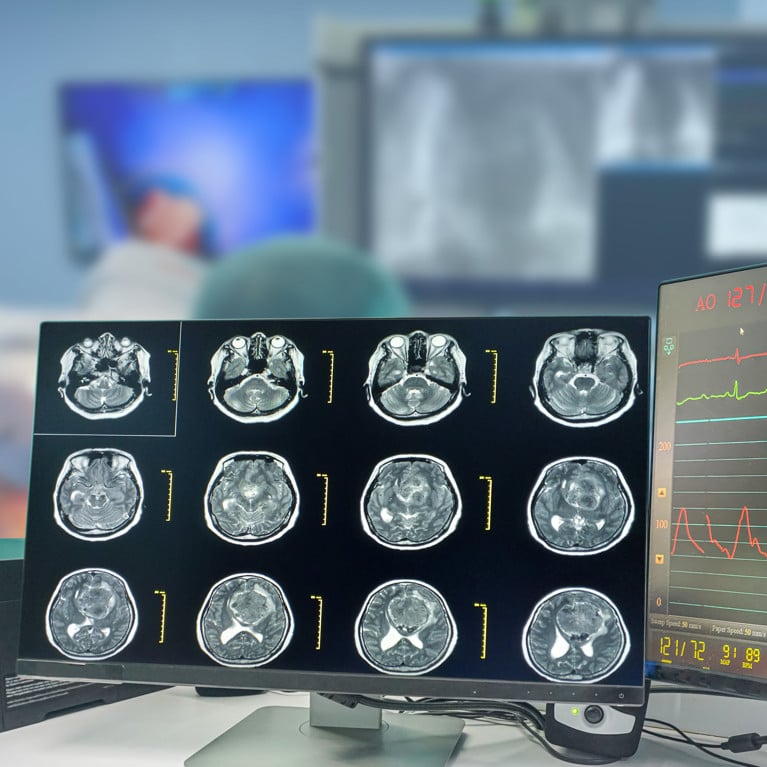 CT Scan brain Finding isodense mass with ill-defined margin and surrounding edema at the Left frontal lobe. Glioblastoma, brain metastasis. Blurry operating room background. See Less
By Richman Photo Adobe Stock