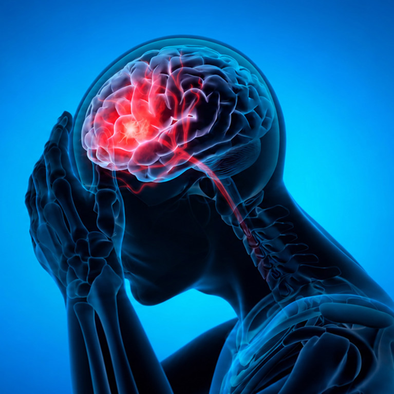three-dimensional medical illustration of a person suffering from a stroke.