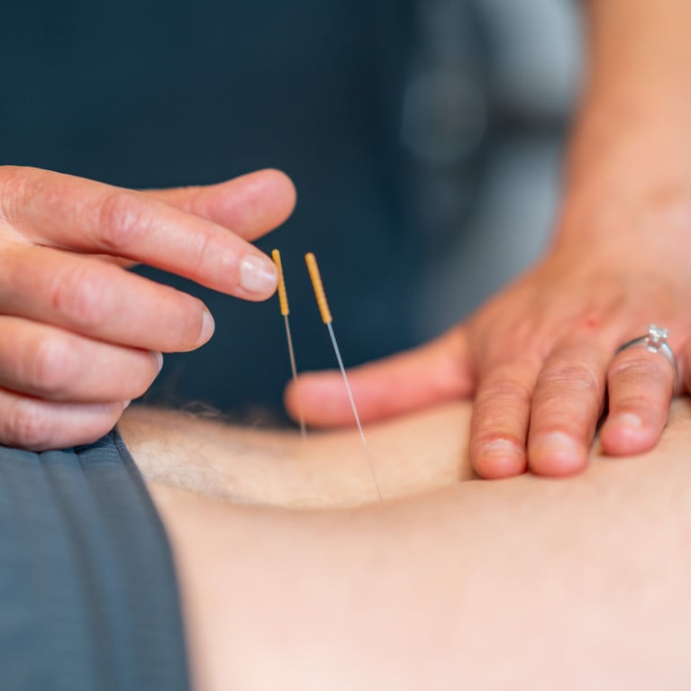 Closeup of physiotherapy dry needling on a person's back. Picture: Noah/Adobe Stock