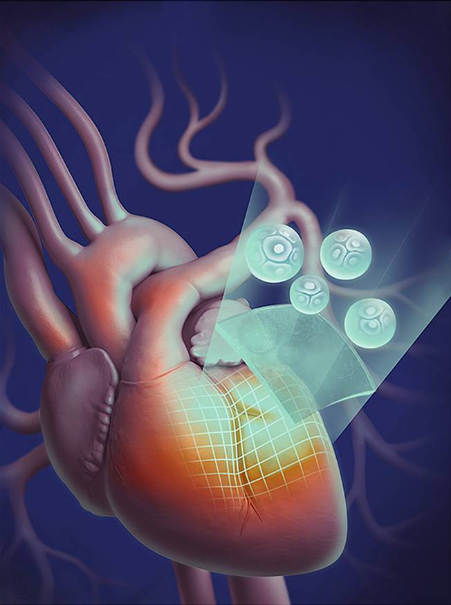 An illustration of an anatomical heart with a patch made of stem cells being applied to it