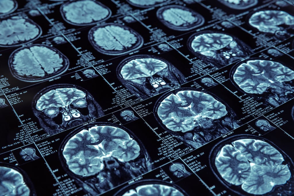 Multiple MRI scans showing cross-sectional images of the human brain.
