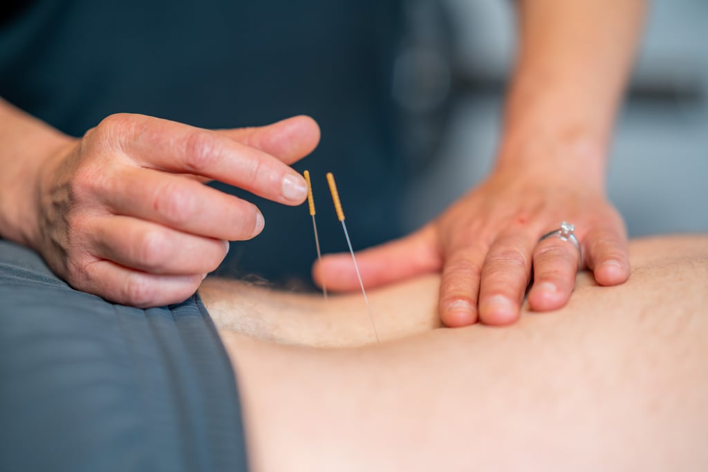 Closeup of physiotherapy dry needling on a person's back. Picture: Noah/Adobe Stock