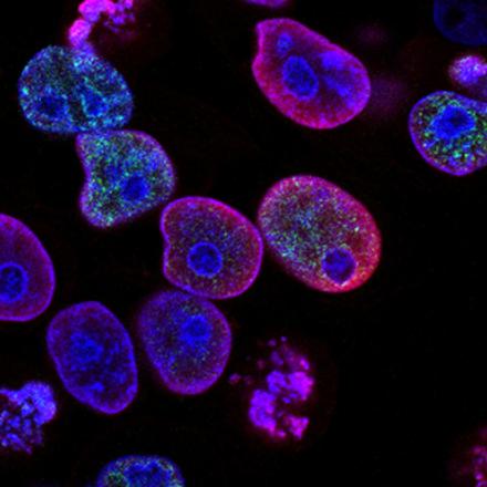 Human cancer cells stained blue and pink