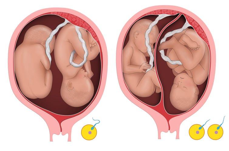 Diagram of identical twins in the womb and non-identical twins in the womb