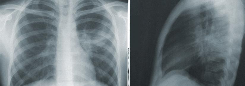 front and profile x-rays of chest